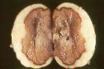 Photo of Pythium leak on potato
